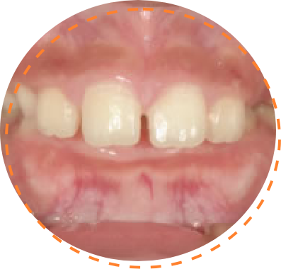 出っ歯の傾向が強い（上顎前突）