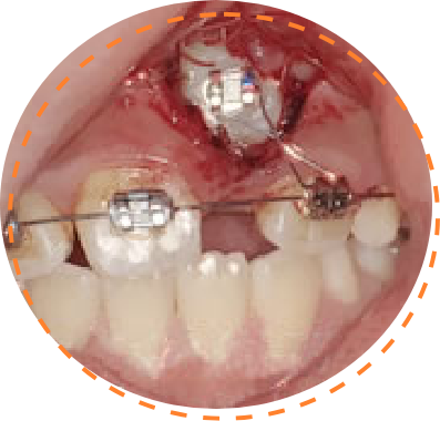 歯の生えてくる位置が悪く、骨の中に埋まってしまう場合