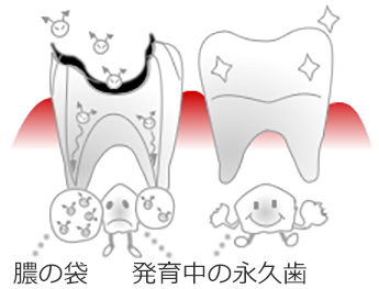 永久歯の形成不全（減形成）