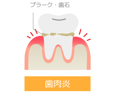 歯周病 ～ 歯肉炎を起こしている歯ぐき