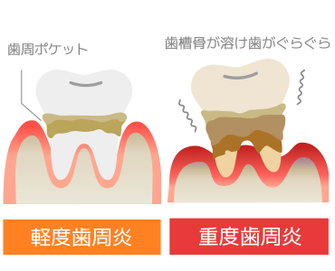 歯周病 ～ 歯周炎を起こしている歯ぐき