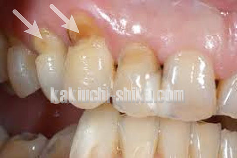 知覚過敏の典型的な症例。歯肉が下がったりエナメル質が削れたりして象牙質が剥きだしになっている。